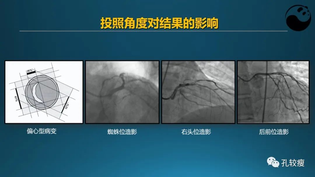 从零开始,掌握冠脉造影读片要领
