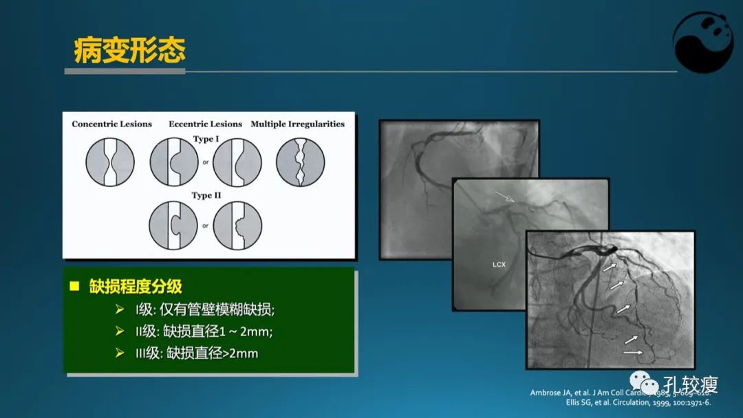 从零开始,掌握冠脉造影读片要领