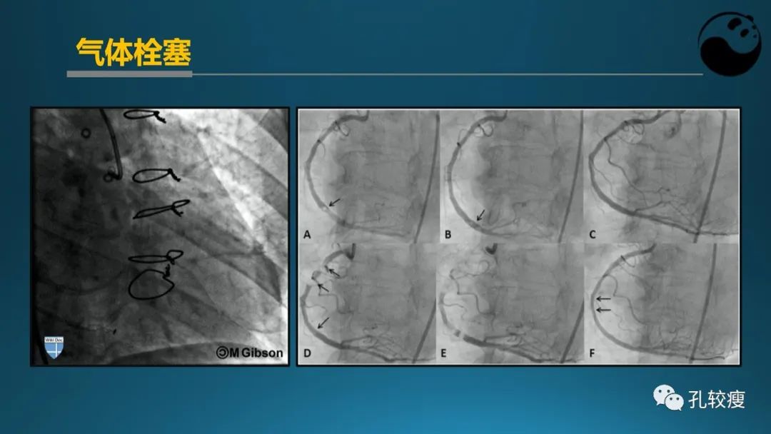 从零开始,掌握冠脉造影读片要领