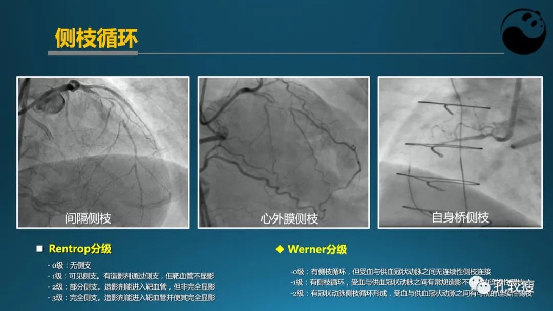 从零开始,掌握冠脉造影读片要领