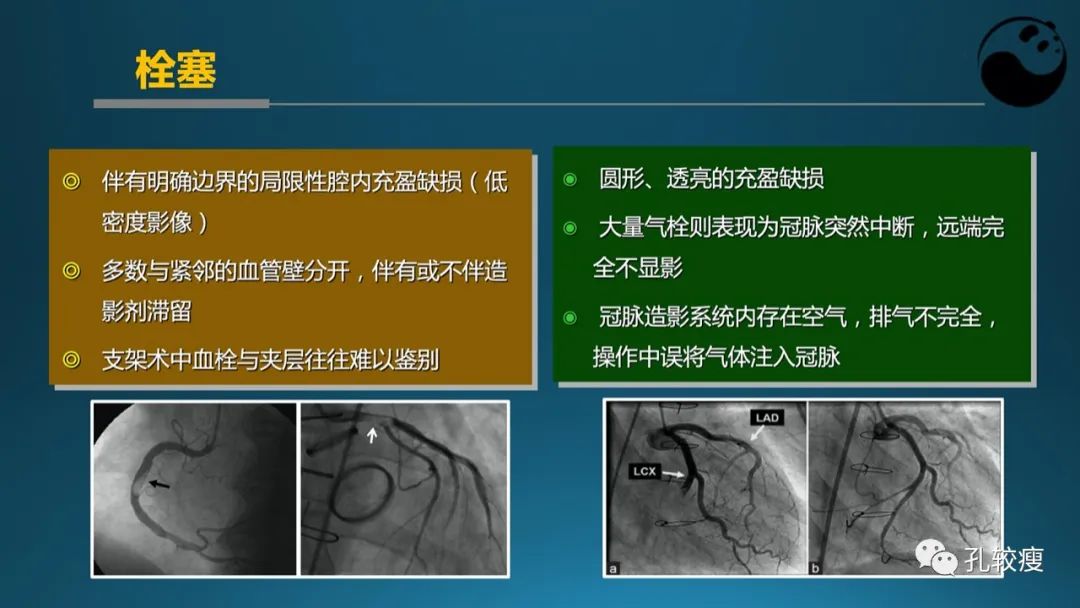 从零开始,掌握冠脉造影读片要领