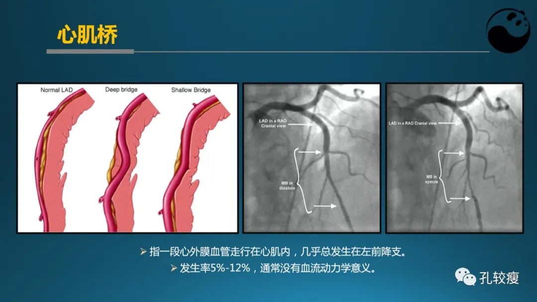 从零开始,掌握冠脉造影读片要领