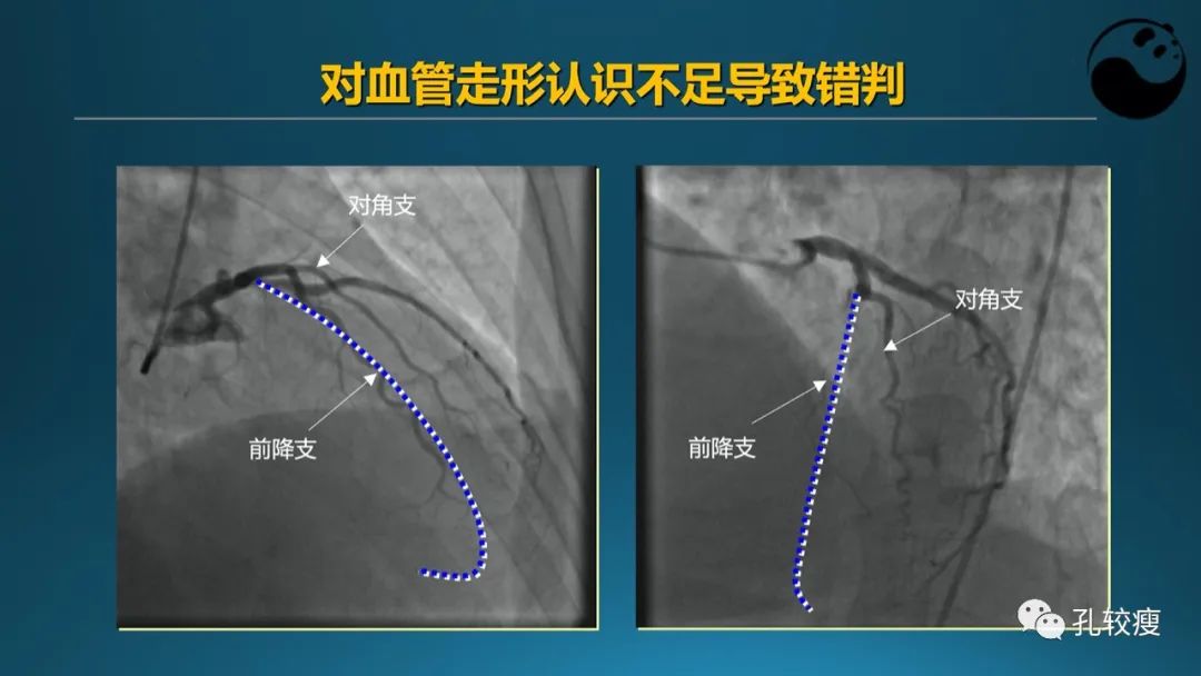 从零开始,掌握冠脉造影读片要领