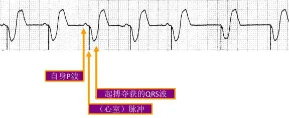 一文读懂心脏起搏器的临床应用
