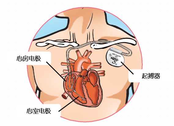 一文读懂心脏起搏器的临床应用