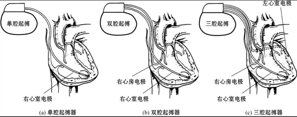 一文读懂心脏起搏器的临床应用