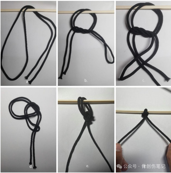 Nice结作为辅助复位技术治疗移位粉碎性锁骨骨折