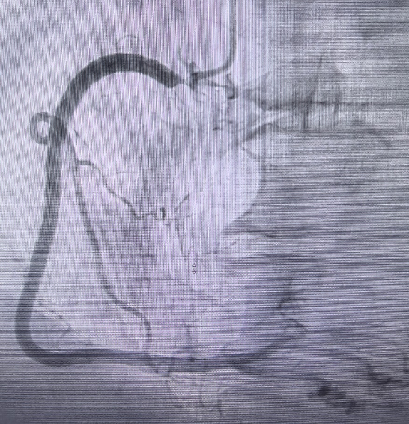 Launcher病例荟 | JR应用于右冠开口病变