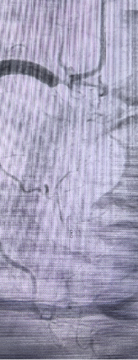 Launcher病例荟 | JR应用于右冠开口病变