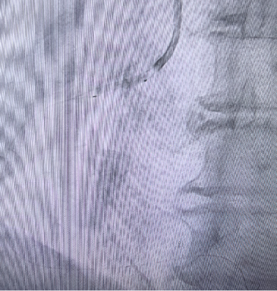 Launcher病例荟 | JR应用于右冠开口病变