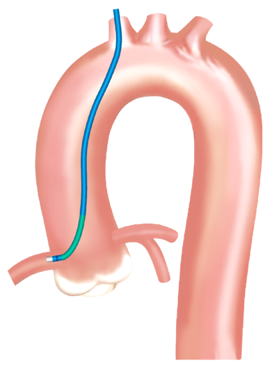 Launcher病例荟 | JR应用于右冠开口病变