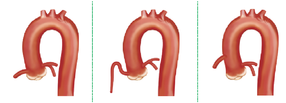 Launcher病例荟 | JR应用于右冠开口病变