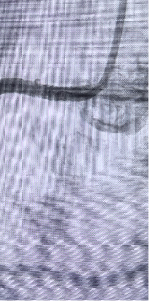 Launcher病例荟 | JR应用于右冠开口病变