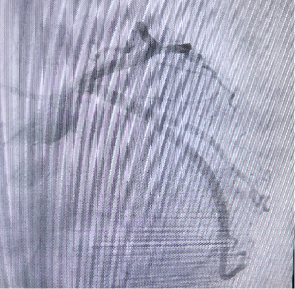 Launcher病例荟 | JR应用于右冠开口病变