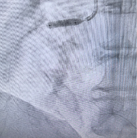 Launcher病例荟 | JR应用于右冠开口病变