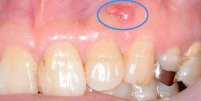 ​瘘管治疗的灵活处理