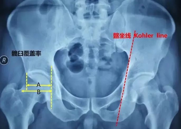 做好初次髋关节置换,这些技巧你掌握了吗?