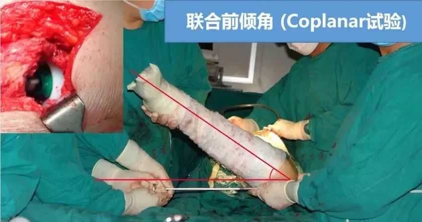 做好初次髋关节置换,这些技巧你掌握了吗?