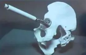 做好初次髋关节置换,这些技巧你掌握了吗?