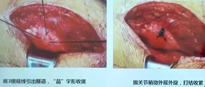 做好初次髋关节置换,这些技巧你掌握了吗?