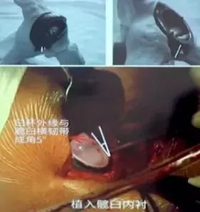 做好初次髋关节置换,这些技巧你掌握了吗?