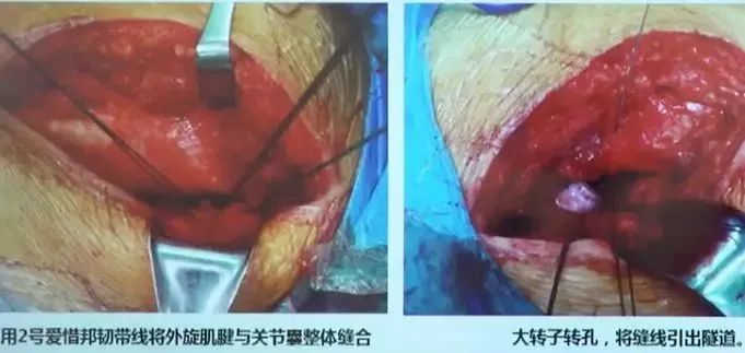做好初次髋关节置换,这些技巧你掌握了吗?