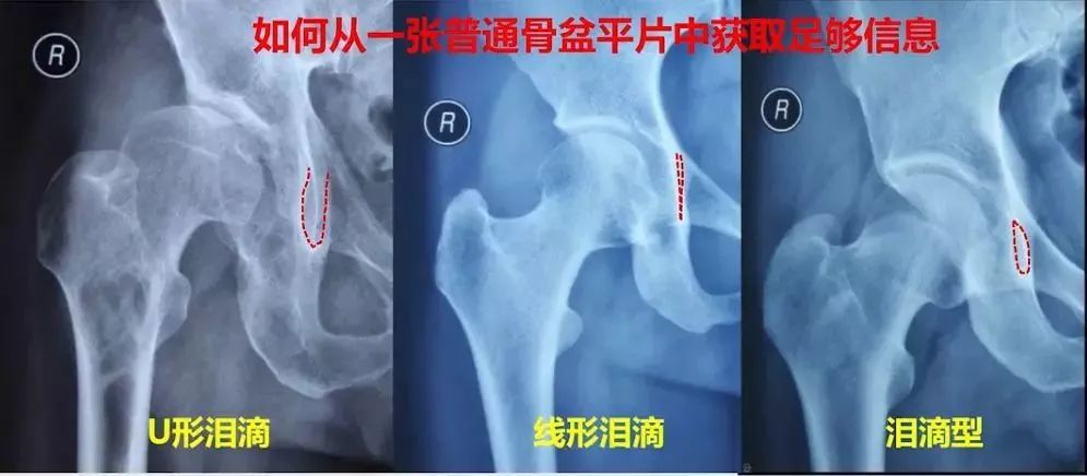 做好初次髋关节置换,这些技巧你掌握了吗?