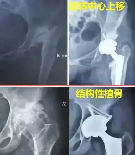 做好初次髋关节置换,这些技巧你掌握了吗?