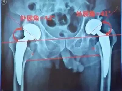做好初次髋关节置换,这些技巧你掌握了吗?