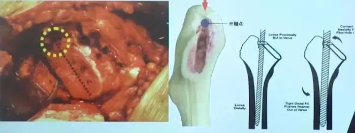 做好初次髋关节置换,这些技巧你掌握了吗?