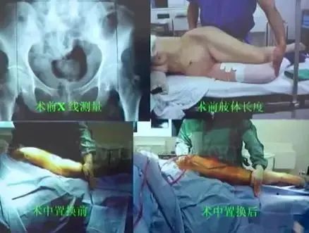 做好初次髋关节置换,这些技巧你掌握了吗?