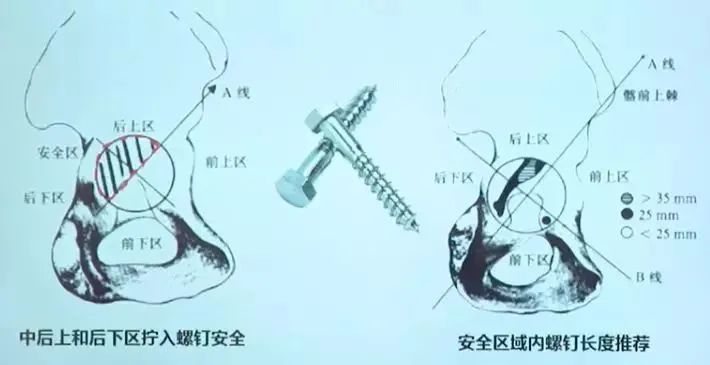 做好初次髋关节置换,这些技巧你掌握了吗?