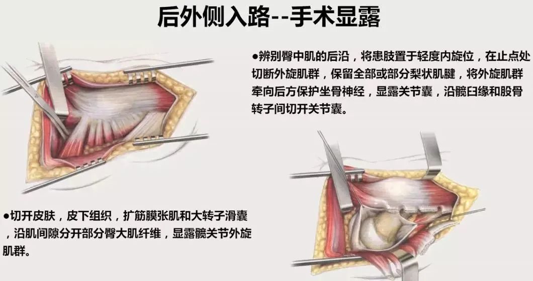 做好初次髋关节置换,这些技巧你掌握了吗?