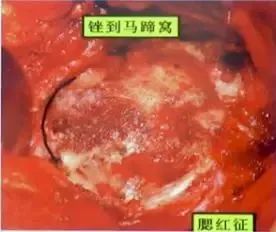做好初次髋关节置换,这些技巧你掌握了吗?