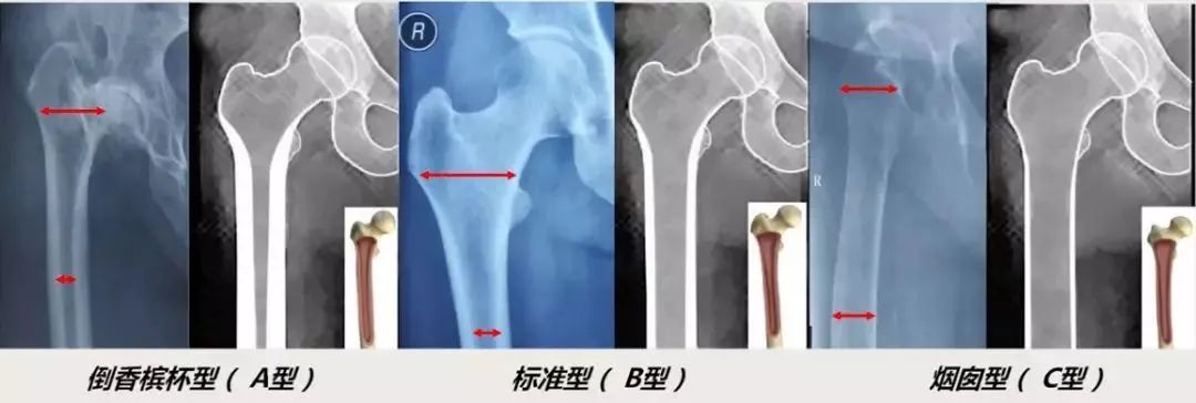 做好初次髋关节置换,这些技巧你掌握了吗?