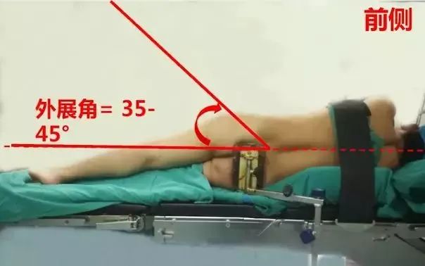 做好初次髋关节置换,这些技巧你掌握了吗?