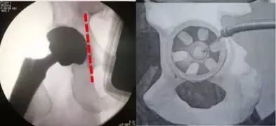 做好初次髋关节置换,这些技巧你掌握了吗?