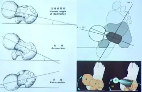 做好初次髋关节置换,这些技巧你掌握了吗?