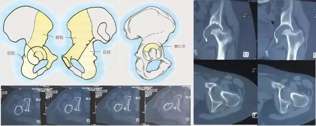 做好初次髋关节置换,这些技巧你掌握了吗?
