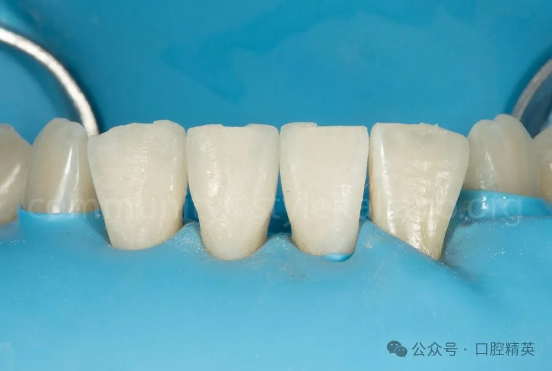 下前牙关闭间隙;不备牙瓷贴面修复