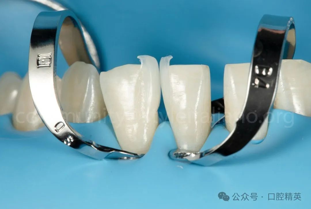 下前牙关闭间隙;不备牙瓷贴面修复