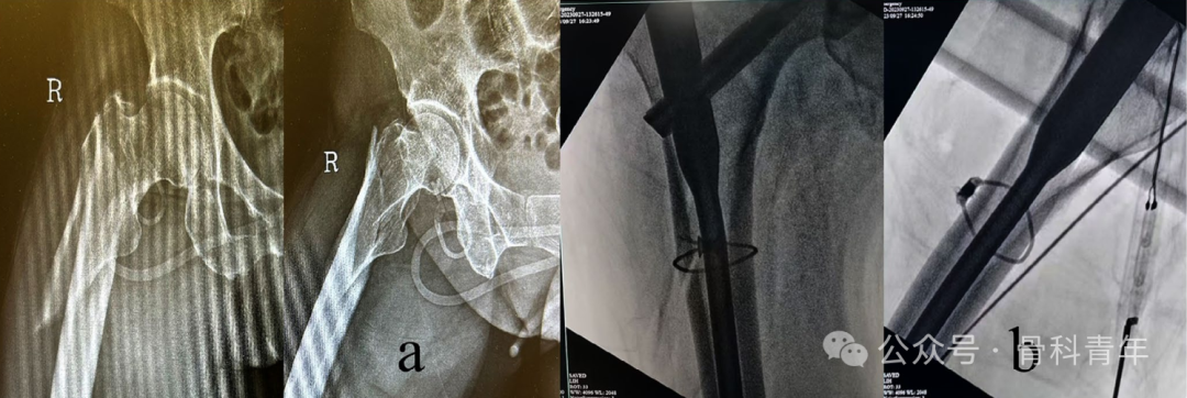 手术技巧|“血管钳撬拨技术”辅助复位粗隆下骨折