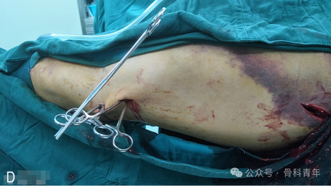手术技巧|“血管钳撬拨技术”辅助复位粗隆下骨折