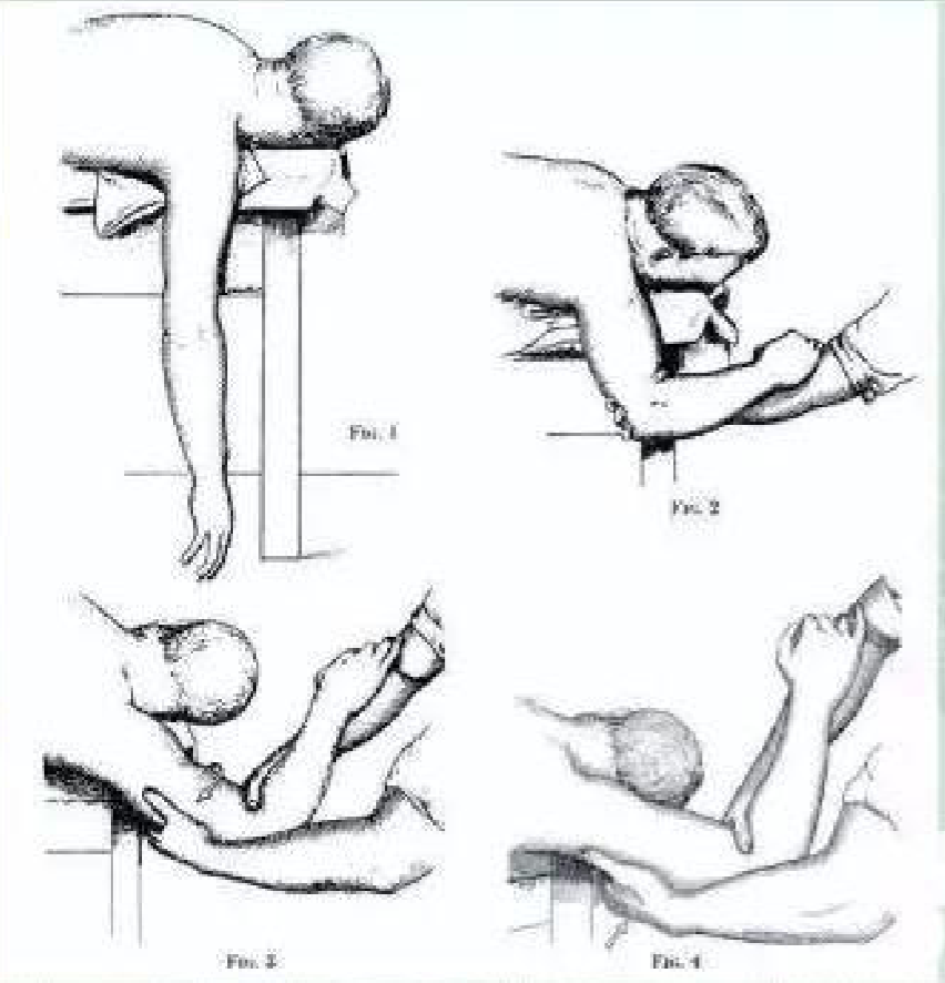 这11种肩关节脱位复位方法,看看你都会了吗?