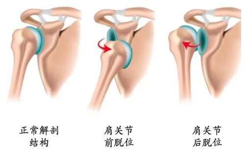 这11种肩关节脱位复位方法,看看你都会了吗?