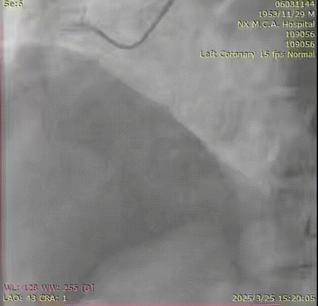 Launcher病例荟 | SAL.75/1.0应用于右冠钙化病变