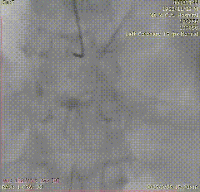 Launcher病例荟 | SAL.75/1.0应用于右冠钙化病变