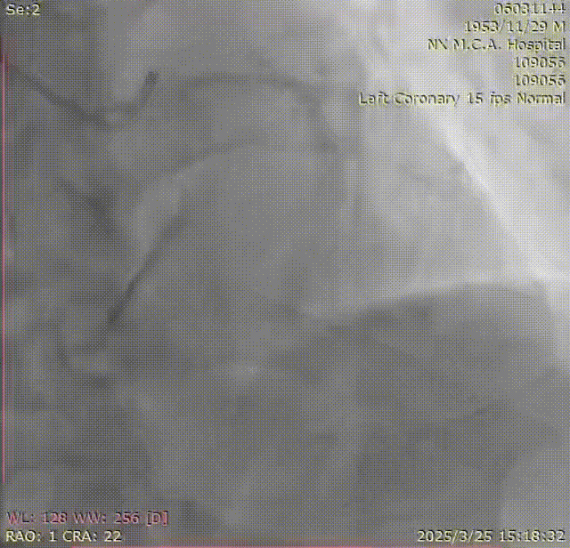 Launcher病例荟 | SAL.75/1.0应用于右冠钙化病变