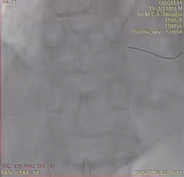 Launcher病例荟 | SAL.75/1.0应用于右冠钙化病变