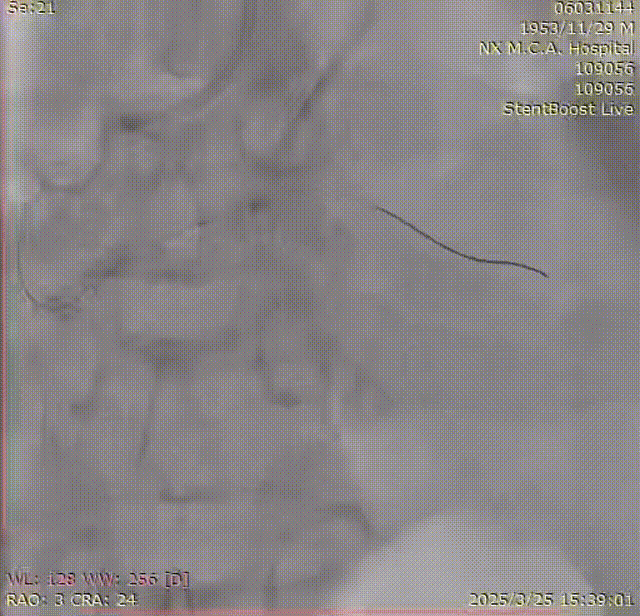 Launcher病例荟 | SAL.75/1.0应用于右冠钙化病变